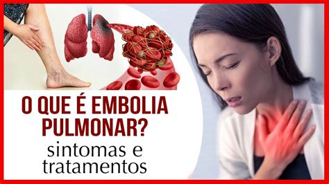 O que é Embolia Pulmonar Sintomas e Tratamentos