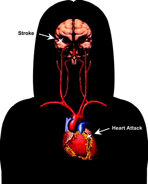 Heart Attack And Stroke Prevention In Women Circulation