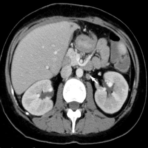 Abdomen Ct 1 Month After A Second Hsct Multiple Conglomerated