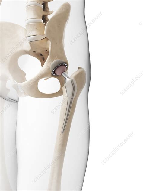 Human Hip Replacement Artwork Stock Image F009 6896 Science Photo Library