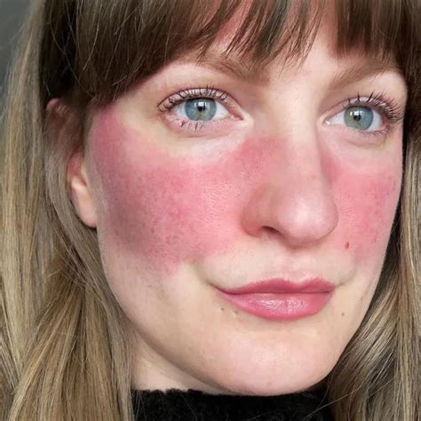 Rosacea Facial Flushing One Cosmetic
