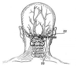 Peripheral Nerve Stimulation Image Occipital Neuralgia Neuralgia