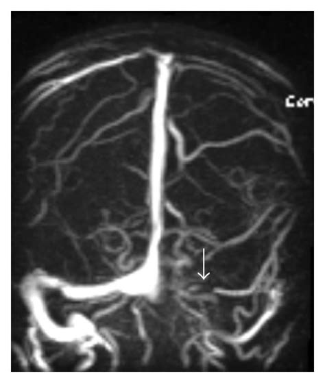 Dural Venous Sinus Thrombosis As An Only Imaging Evidence Of