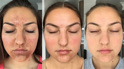 My Accutane Experience How I Got Clear Skin Before After Pictures