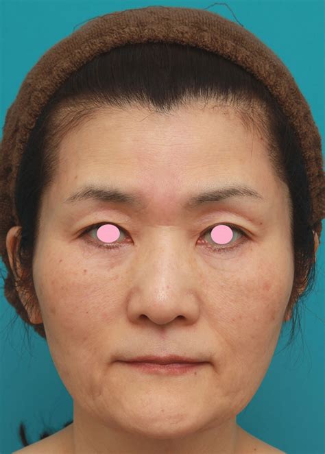 50代後半女性のたるんだ顔に脂肪溶解注射を行って小顔にした症例写真：美容外科 高須クリニック