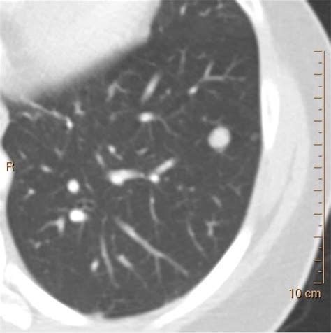 Lung Nodule Spectral And Volumetric — Spectral Ct