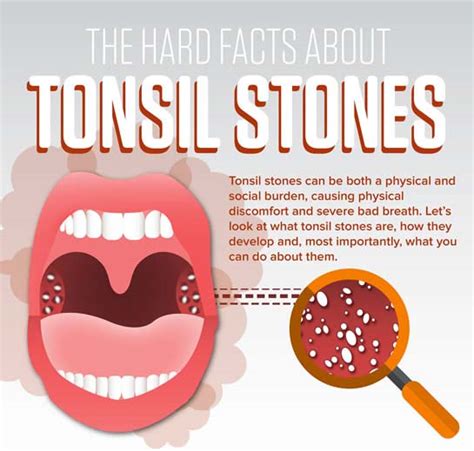 The Hard Facts About Tonsil Stones Infographic