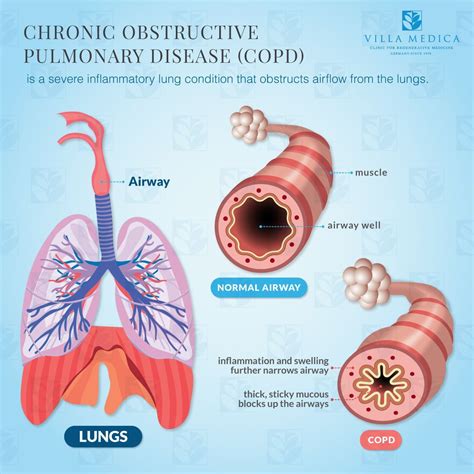 MEDICAL SCHOOL CHRONIC OBSTRUCTIVE PULMONARY DISEASE WHAT TO KNOW