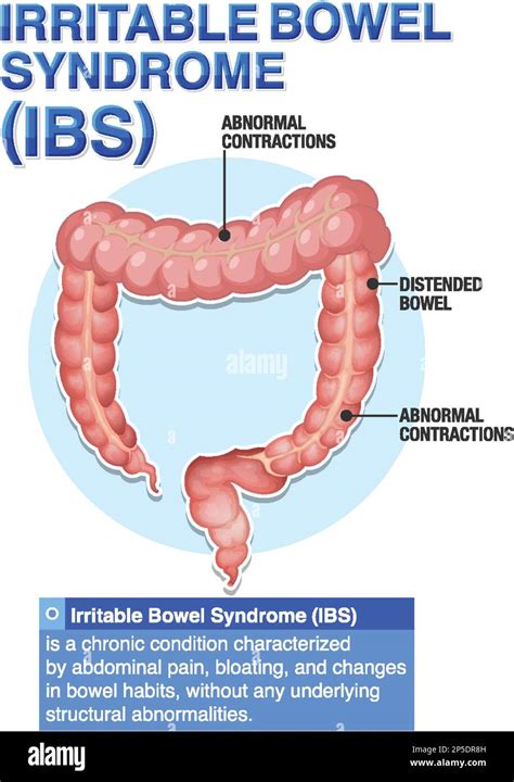 Irritable Bowel Syndrome Ibs Infographic Illustration Stock Vector