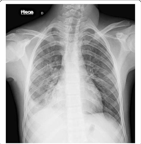 Chest X Ray On The Day Of Discharge There Was A Small Heterogeneous