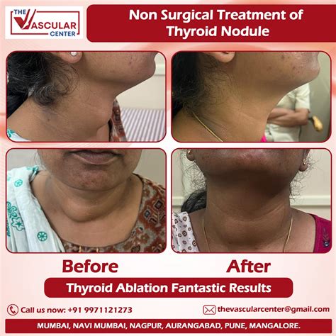 Thyroid Ablation Thyroid Nodule Treatment Without Surgery In Mumbai