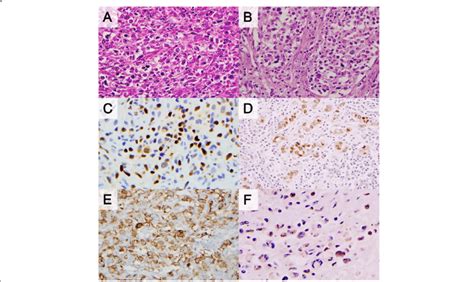 Pathologic Findings Of Primary Mediastinal Large B Cell Lymphoma