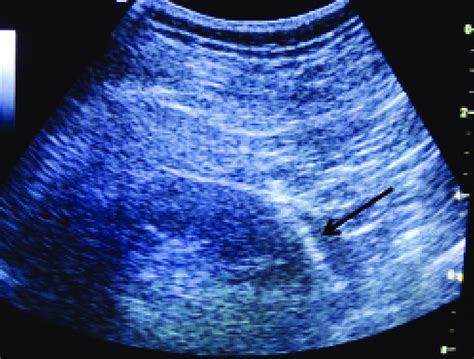 Ultrasound Image Obtained During Percutaneous Renal Biopsy Arrow