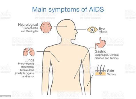 Diagram Of Main Symptoms Of Aids Stock Illustration Download Image