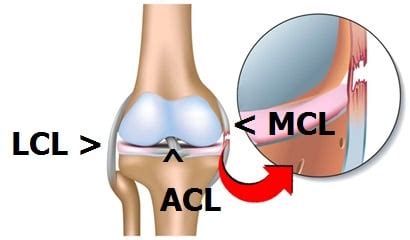 Grade iii tears refer to a complete tear of the lcl. Recovery From An MCL Injury? - Howard J. Luks, MD