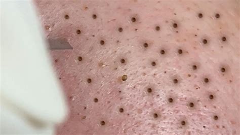 Huong Da Nang Acne Treatment (#386) #Huongdanang - YouTube