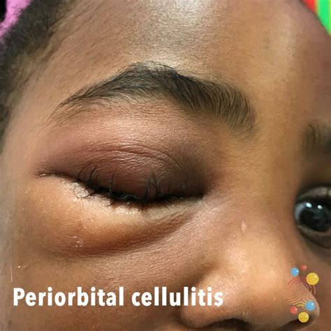 Peri Orbital Cellulitis Skin Deep