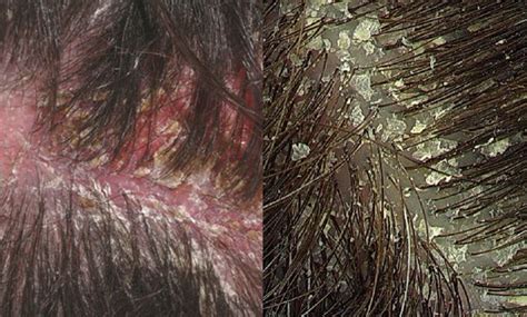 (it's different from psoriasis, which also can look like flakes — but those will appear like. Best Scalp Dryness & Dandruff Treatment, Cost in Mumbai ...