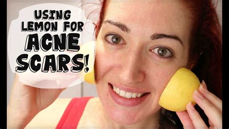 How Long Does Lemon Juice Take To Fade Acne Scars