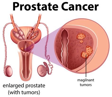 Prostate Cancer South Valley Urology
