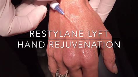 Restylane Lyft Hand Rejuvenation Done With Cannulas By Expert Injector