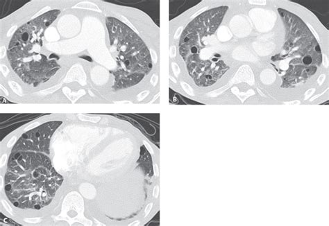 66 Pneumocystis Pneumonia Radiology Key