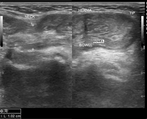 Inguinal And Umbilical Hernia Image