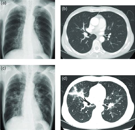 Follow Up Chest X Ray And Computed Tomography A And B Before Treating