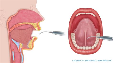 Frenectomy Tongue Tie Procedure Youtube