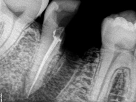 Sevadharma Dental Clinic Rvgs Of Hemisection Case