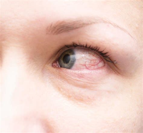 Many Causes Of Red Eye Metrolina Eye Associates