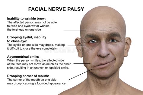 Facial Palsy In A Man 3d Illustration Highlighting The Asymmetry And
