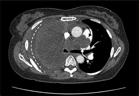 Axial Image Of The Chest From Cta Pulmonary Exam Shows A Pleural