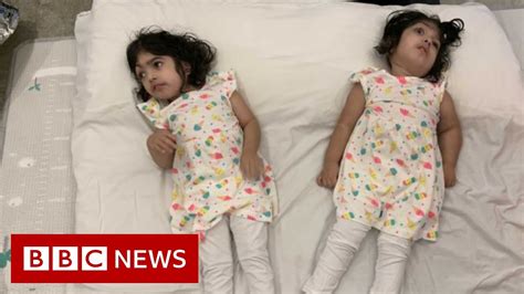 Conjoined Twins Return Home After Successful Separation Bbc News Youtube