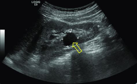 Renal Sinus Cyst