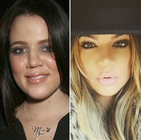 khloe kardashian before and after plastic surgery 05 celebrity plastic surgery online