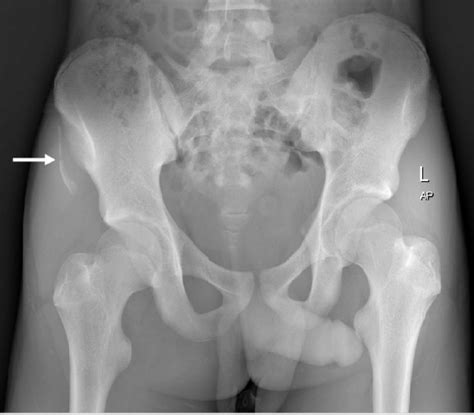 Plain Pelvis Radiograph Showing Avulsion Fracture Of Right Anterior