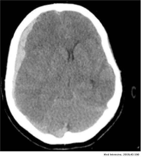 Spontaneous Acute Subdural Hematoma An Unusual Presentation Of