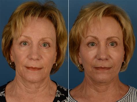 The Uplift Lower Face And Neck Lift Photos Naples Fl Patient 14422