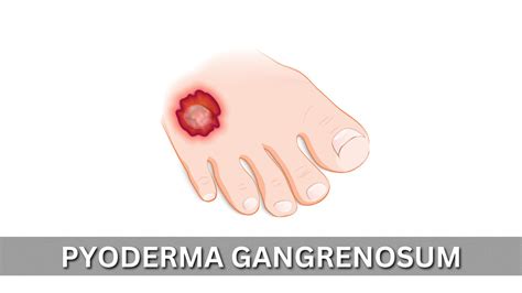 Pyoderma Gangrenosum Causes Symptoms Treatment And More