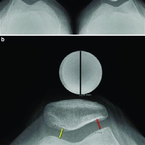 A Standing Skyline View Of The Knees The 25 Mm Iron Ball Used To