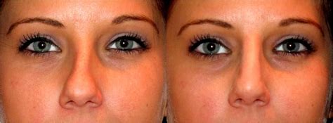 There are different strokes and contouring that can help you improve the profile of your nose. Crooked to straight in minutes-non surgical nose job | Nose reshaping, Nose job, Nose