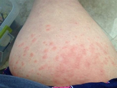 Is It Normal To Have Itchy Legs During Pregnancy Pregnancywalls