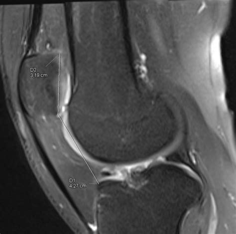 Patellar Tendon Lateral Femoral Condyle Friction Syndrome Image