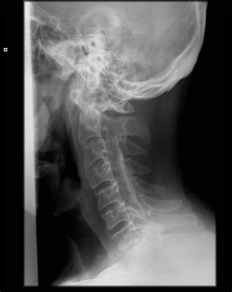Lateral X Ray Of Cervical Spine Anterior Dislocation Open I