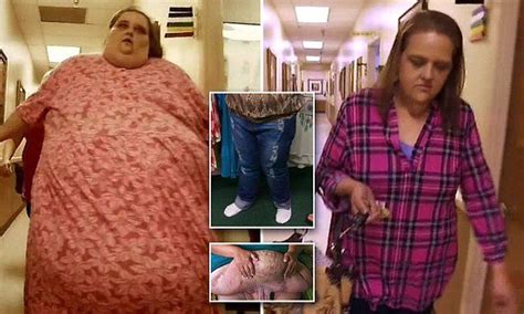 Woman Who Lost 400lbs Has 50lbs Of Excess Skin Removed Weight Loss