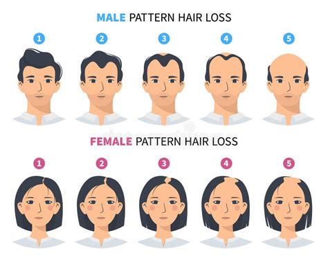 Hair Loss Stages Androgenetic Alopecia Male And Female Pattern Stock