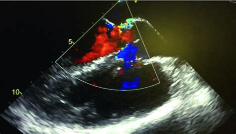 Endoscopic Repair Of Septal Defects Springerlink