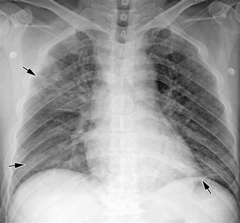 Chest X Ray Pneumonia Vs Bronchitis