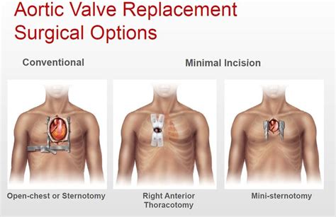Maybe you would like to learn more about one of these? Aortic Valve replacement AVR Surgical Options ...